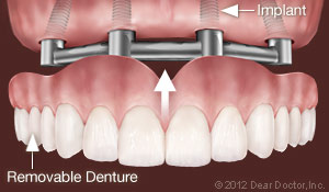 implants-support-removable-dentures
